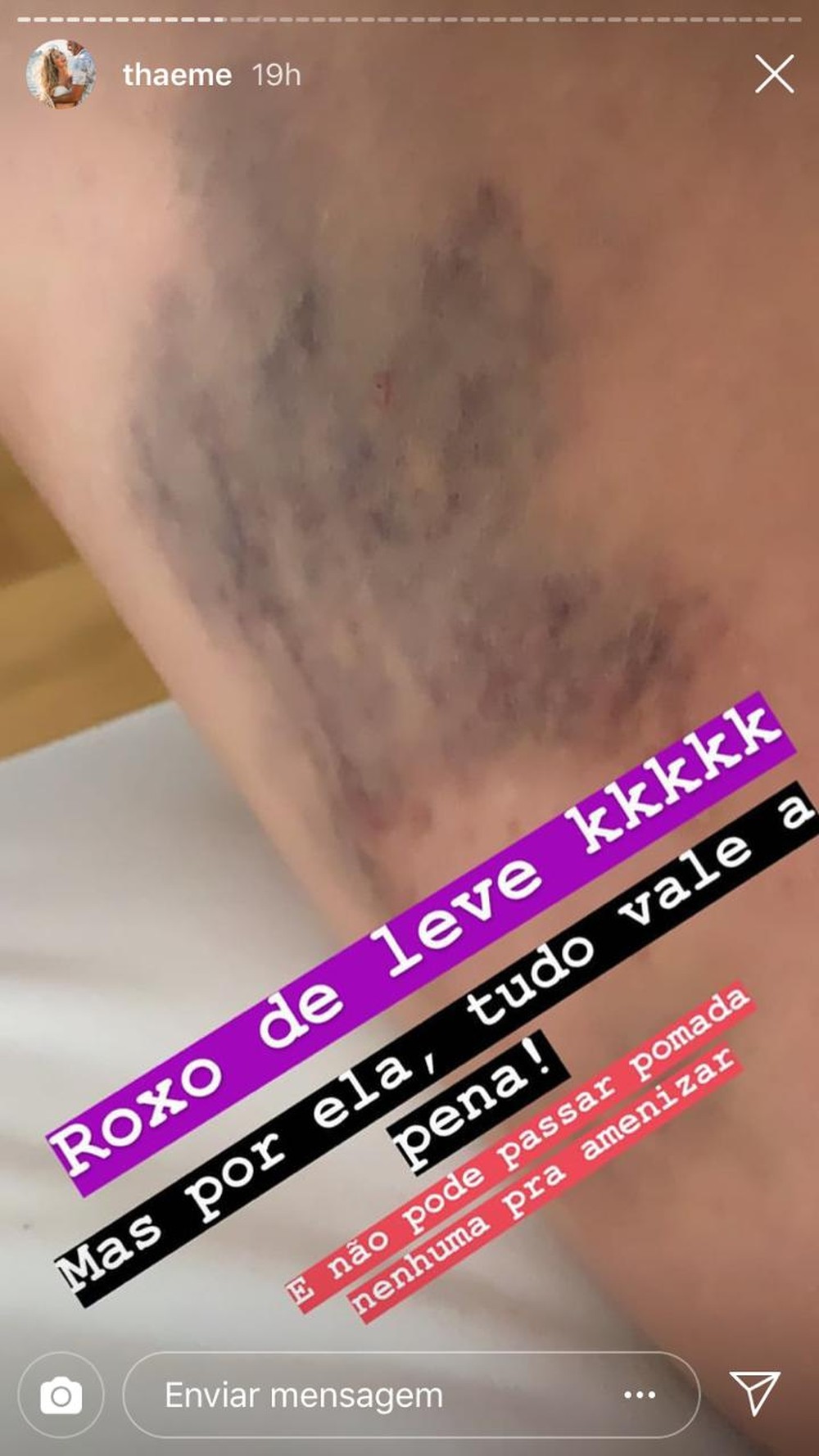 Thaeme mostrou mancha feia no corpo (Foto: Reprodução/Instagram)