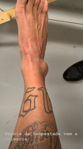 Neymar posta foto provando o quanto se machucou e deixa fãs chocados: "ficou horrível gente"Foto: Reprodução