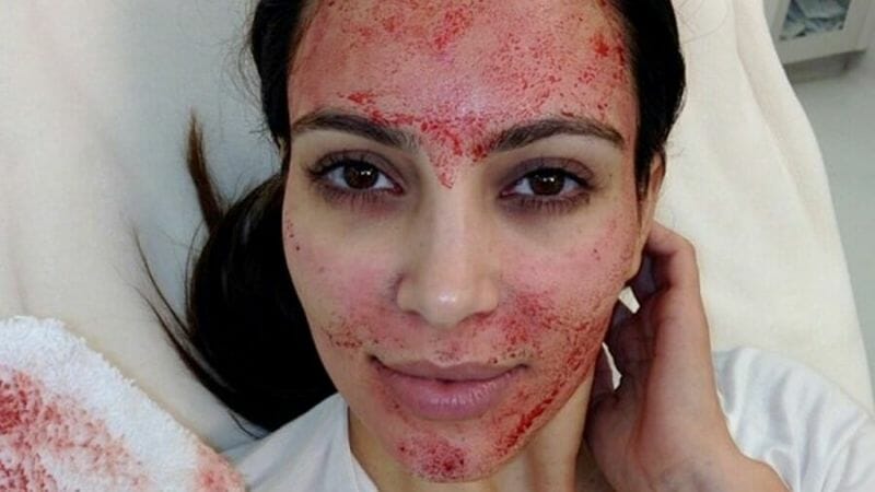 Kim Kardashian processa médico após tratamento facial (Foto: Reprodução)