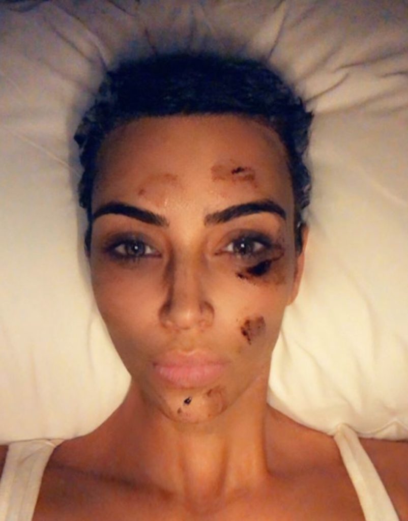 Kim Kardashian sofre de psoríase (Foto: reprodução - Instagram)