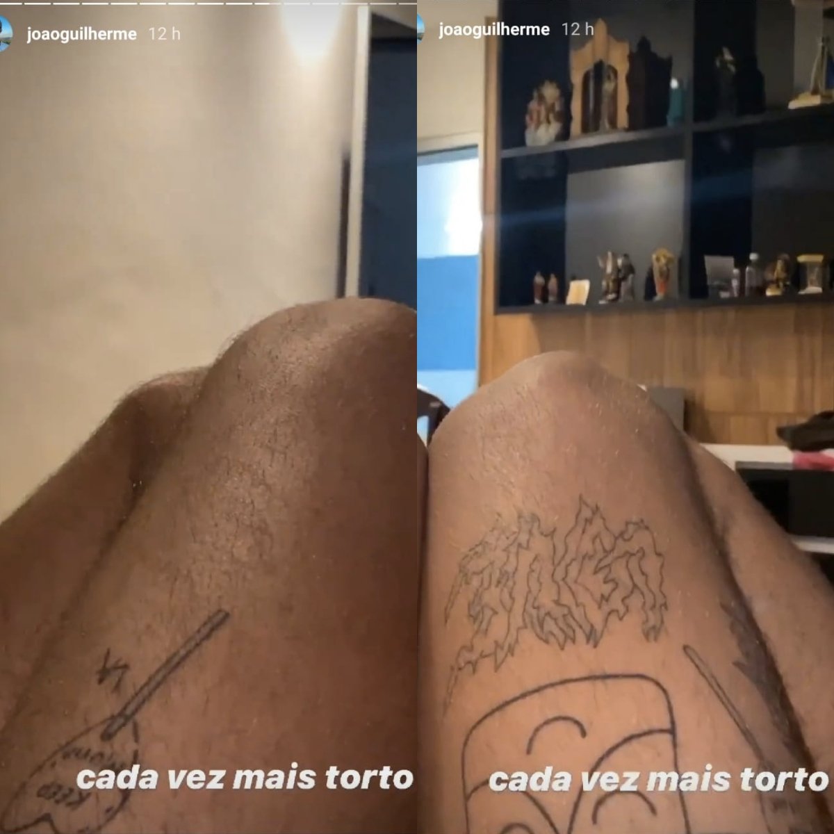 João Guilherme mostrou seu joelho deformado nos stories (Foto: reprodução/Instagram)