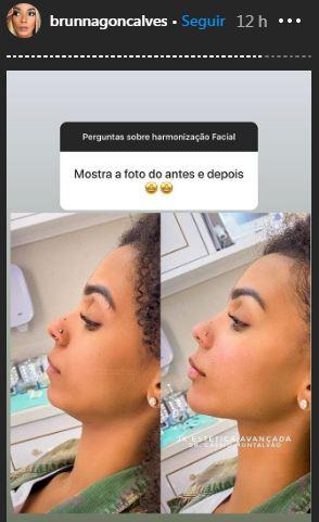 Esposa de Ludmilla, a bailarina Brunna Gonçalves contou que fez harmonização facial (Foto: Reprodução/ Instagram)