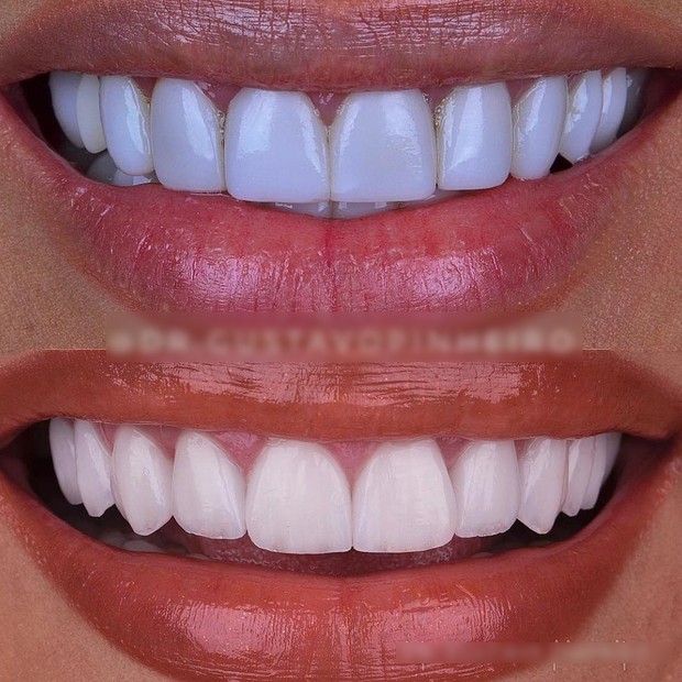 O antes e depois dos dentes de Simaria 