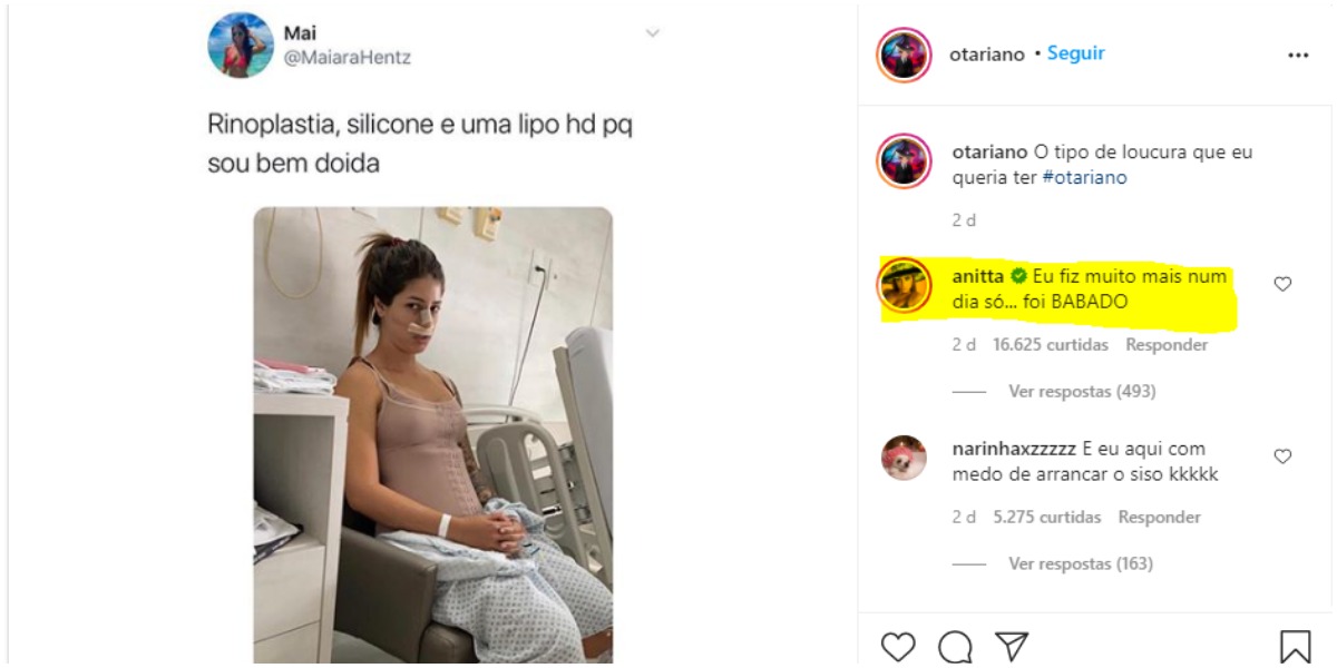 Anitta fala que fez mais de 3 plásticas em um só dia (Foto: Reprodução)