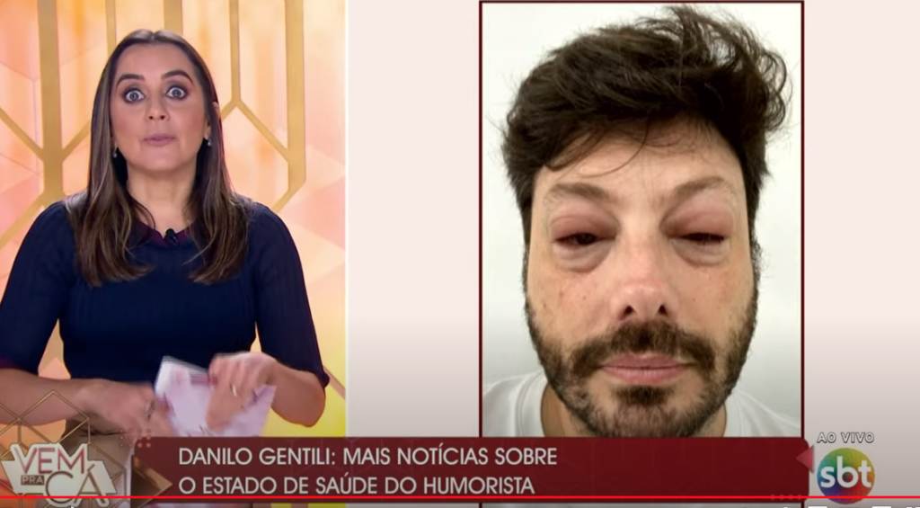 Danilo Gentili ficou com o rosto desfigurado ao vivo (Foto reprodução)