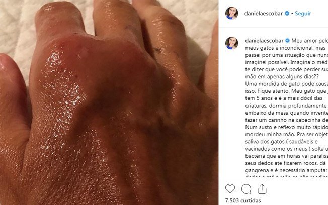 Mão de Daniela Escobar ficou infeccionada após mordida de gato (Foto: Reprodução/Instagram)