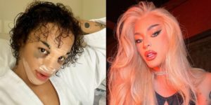 Pabllo Vittar se rendeu a uma cirurgia no nariz (Foto: Reprodução)