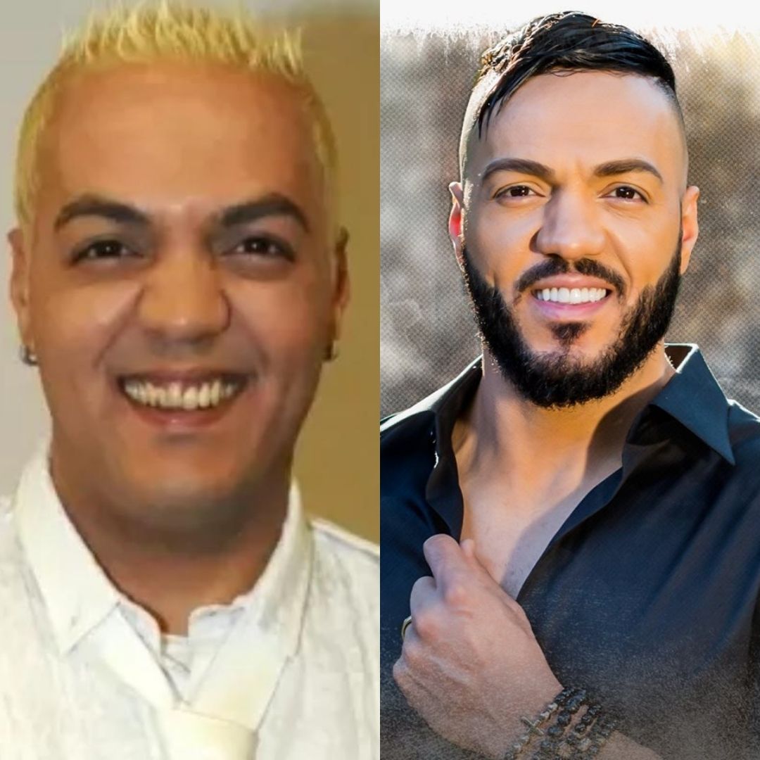 Antes de depois do sorriso do artista Belo