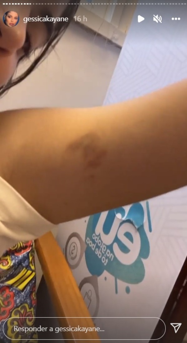 Publicação de Gkay onde ela aparece exibindo os hematomas (Imagem: Reprodução)