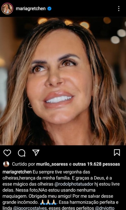 Gretchen fica feliz com resultado do procedimento estético nas olheiras