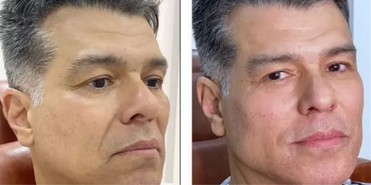 Ator Maurício Mattar antes e depois da  harmonização facial - Foto: Reprodução Instagram