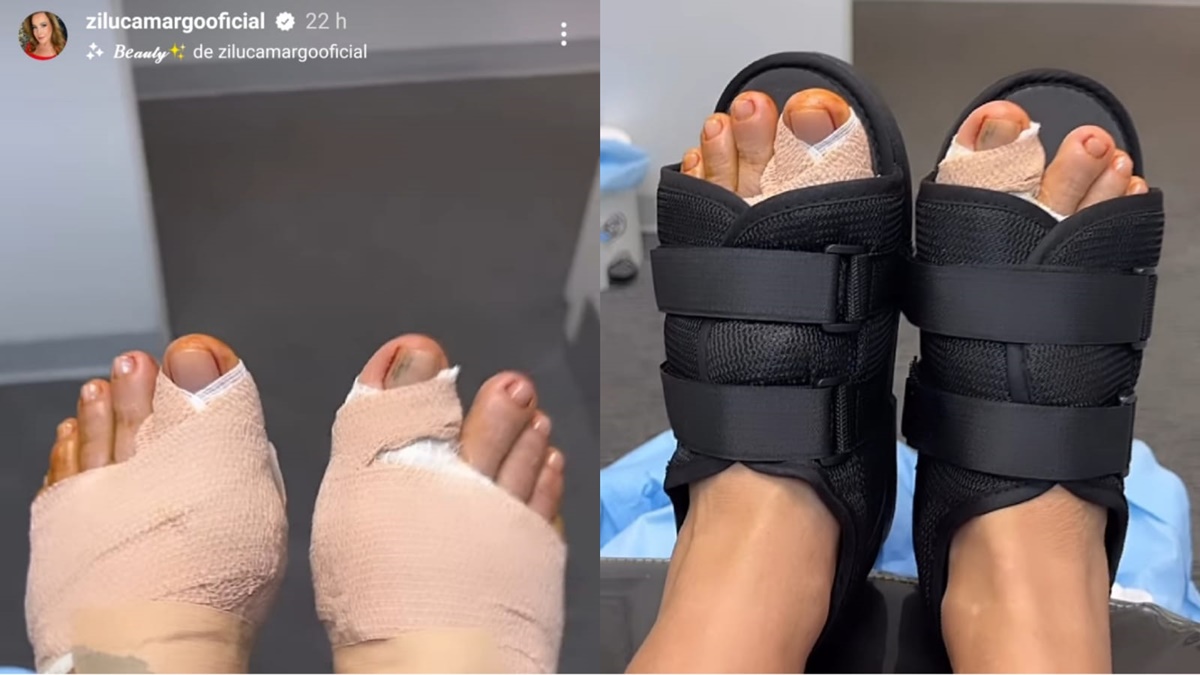 Zilu Camargo passa por cirurgia nos dois pés: ''Tava me prejudicando