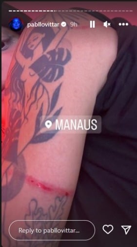 Pabllo Vittar mostra arranhão no braço após queda em show (Foto: Reprodução/Instagram)