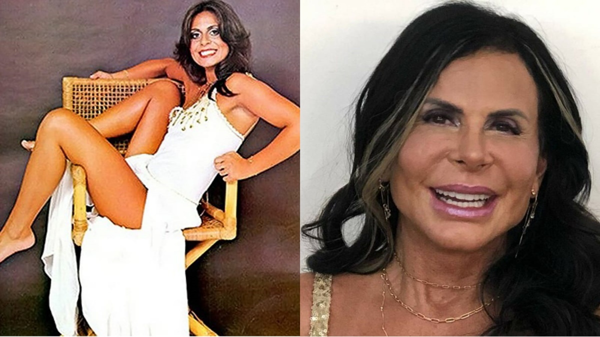 Cantora e Dançarina antes e depois dos procedimentos estéticos 