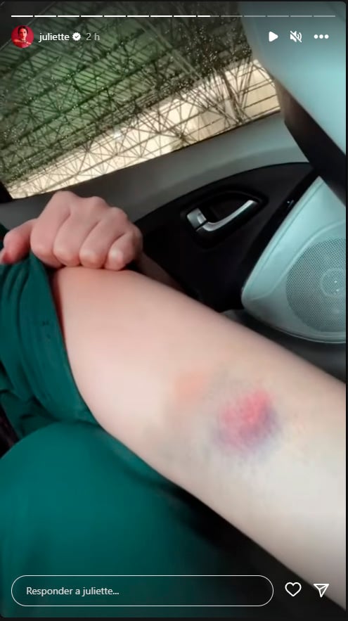 Juliette exibiu hematomas em seu corpo (Imagem: Reprodução)