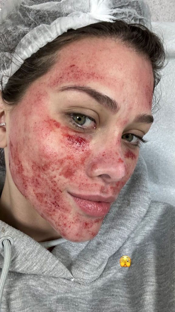 A influenciadora no pós imediato dos procedimentos com o rosto cheio de sangue (instagram)