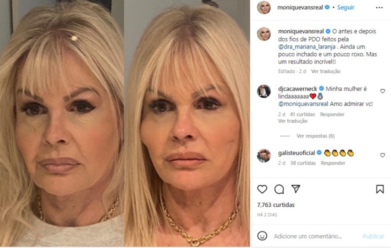 Monique Evans realizou procedimento estético no rosto e surgiu nas redes sociais para mostrar a diferença gritante entre antes e depois para seus fãs e seguidores (Foto: Reprodução/Instagram)