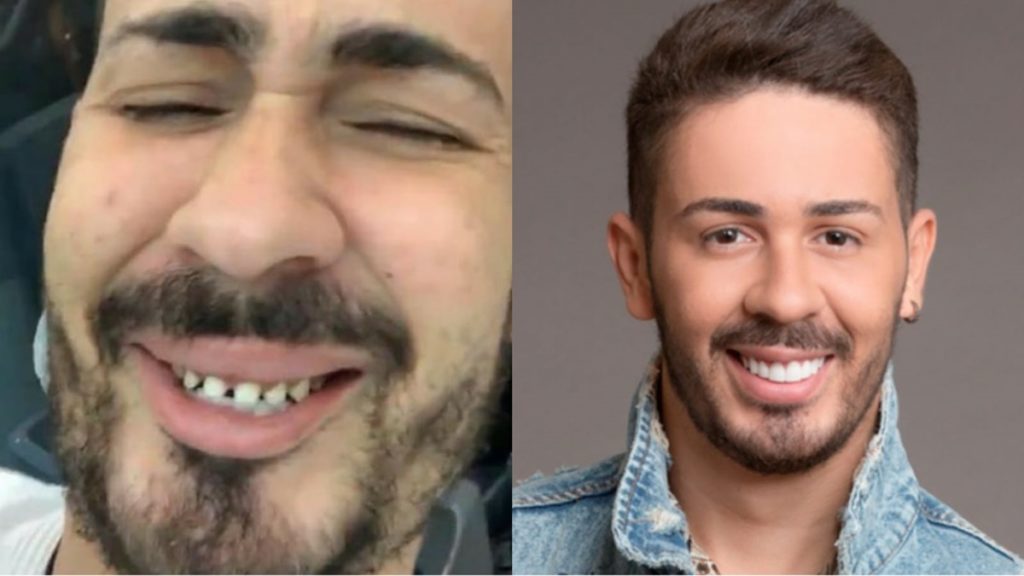 Famosos chocam com fotos antes de lentes nos dentes