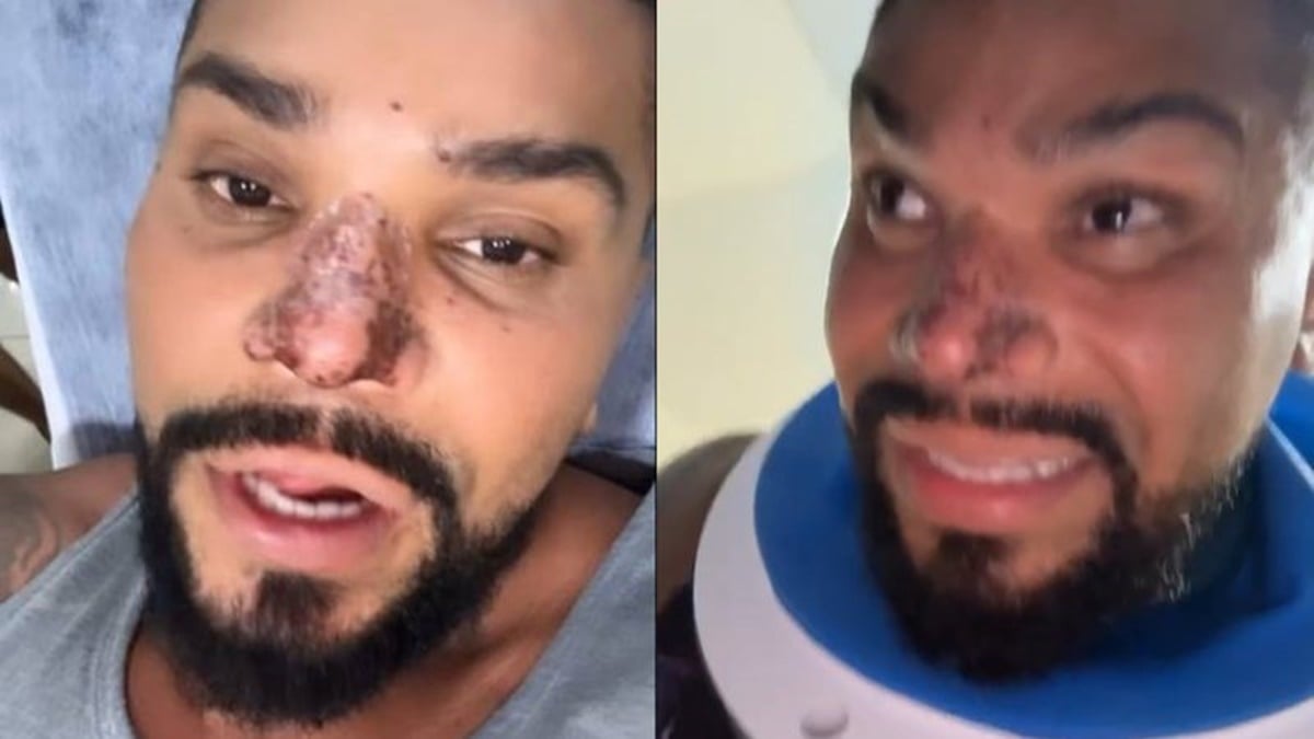 O cantor Naldo Benny ficou com o rosto deformado por causa de uma rinomodelação que não deu certo (Foto: Reprodução / Instagram)