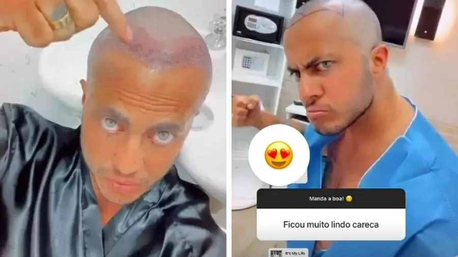 Thammy Miranda, filho de Gretchen, pegou o Brasil de surpresa ao surgir totalmente careca e deu detalhes de procedimento que realizou - Foto Reprodução Instagram