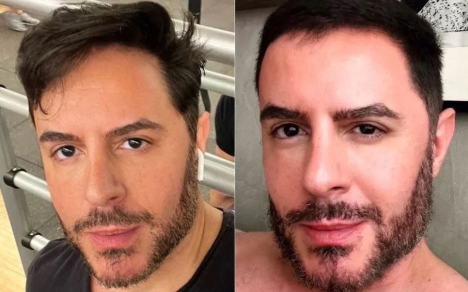 O famoso Ricardo Tozzi, da Globo, passa por procedimento no rosto e antes e depois choca a web - Foto Reprodução