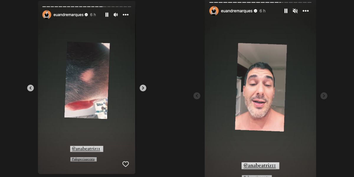 Nas redes sociais, André Marques mostra cabelo caindo, fala sobre alopecia, doença que ocorre perda de cabelo ou de pelo em qualquer parte do corpo, e exibe tratamento por conta do nervosismo (Foto: Reprodução / Instagram)