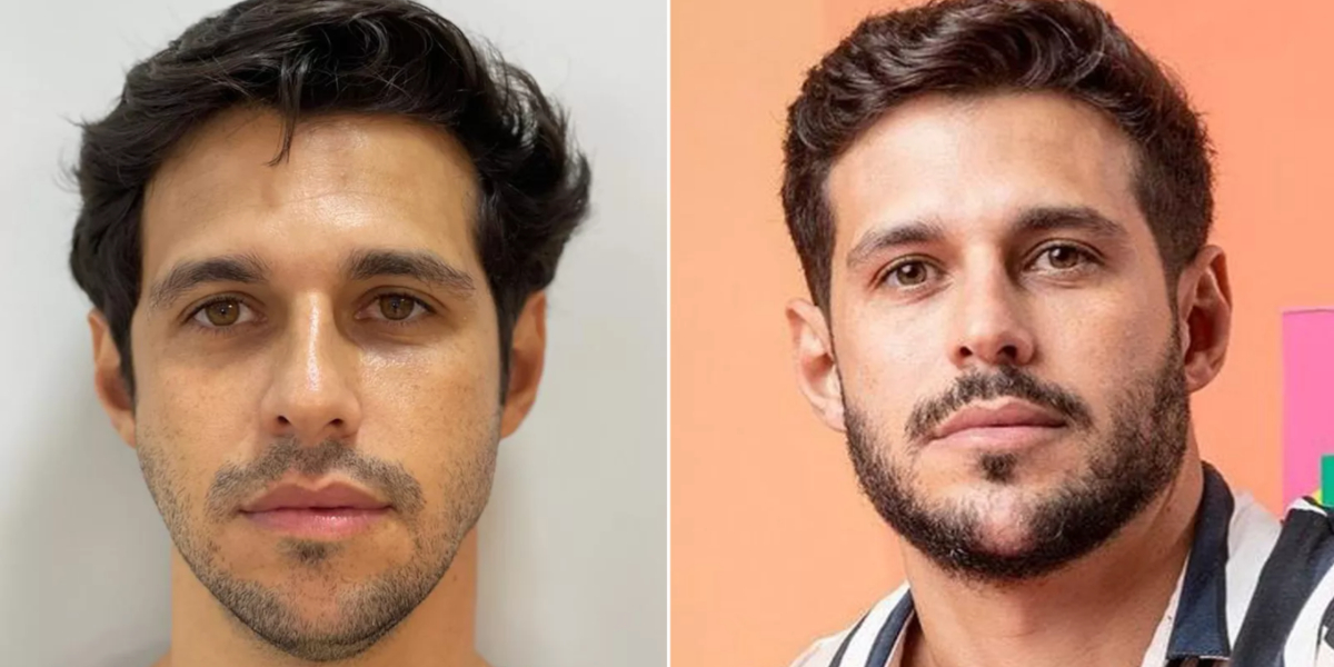 Rodrigo Mussi, do BBB 22, antes e depois do procedimento - Foto: Reprodução/ TV FOCO