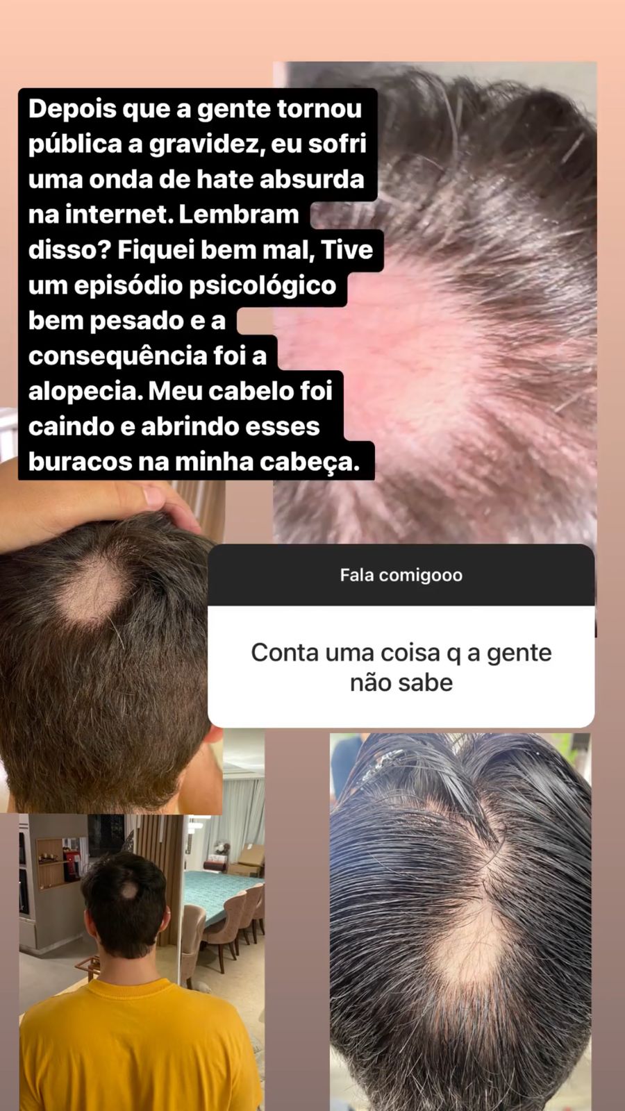 O Ex-BBB, Eliezer, mostrou aos fãs, o resultado da Alopecia, doença que teve logo após a Viih Tube anunciar a gravidez (Reprodução - Instagram)