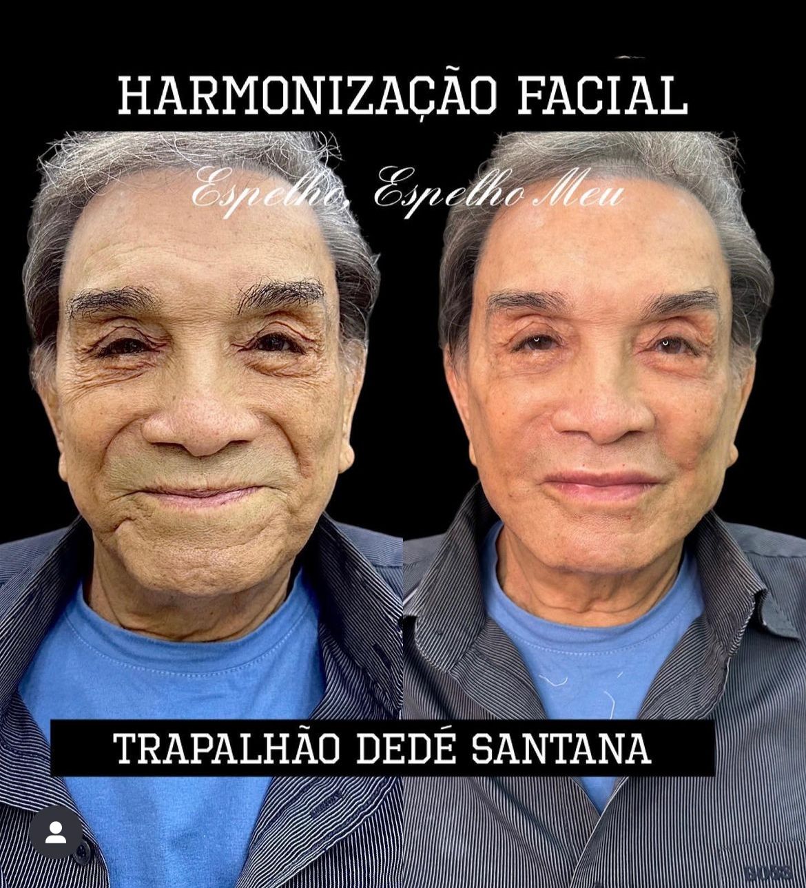 Dedé Santana em antes e depois de procedimento estetico que o rejuvenesceu 30 anos - Foto Reprodução Instagram