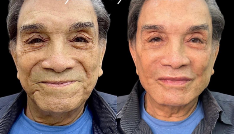 O famoso humorista surpreende com jovialidade ao fazer harmonização facial - Foto Instagram