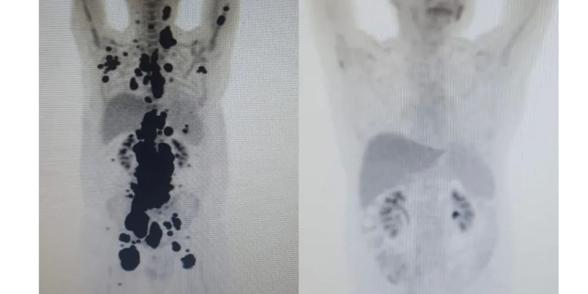 Exames mostram antes e depois de câncer de paciente (Foto: Reprodução / G1) 