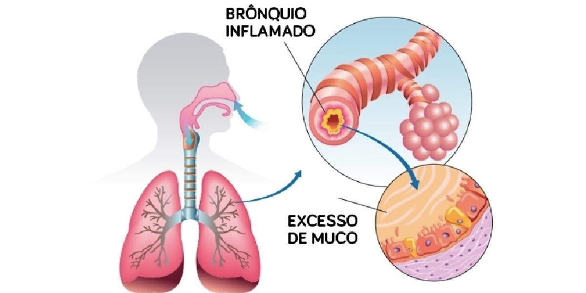 Bronquiolite (Reprodução/Internet)