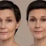 Ingrediente, antes e depois de pele e agulha de botox (Fotos: Reproduções / Freepik)