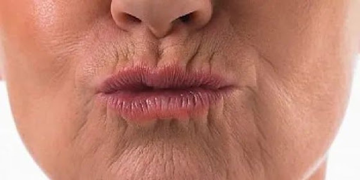 Rugas na boca de senhora (Foto: Reprodução/ Internet)