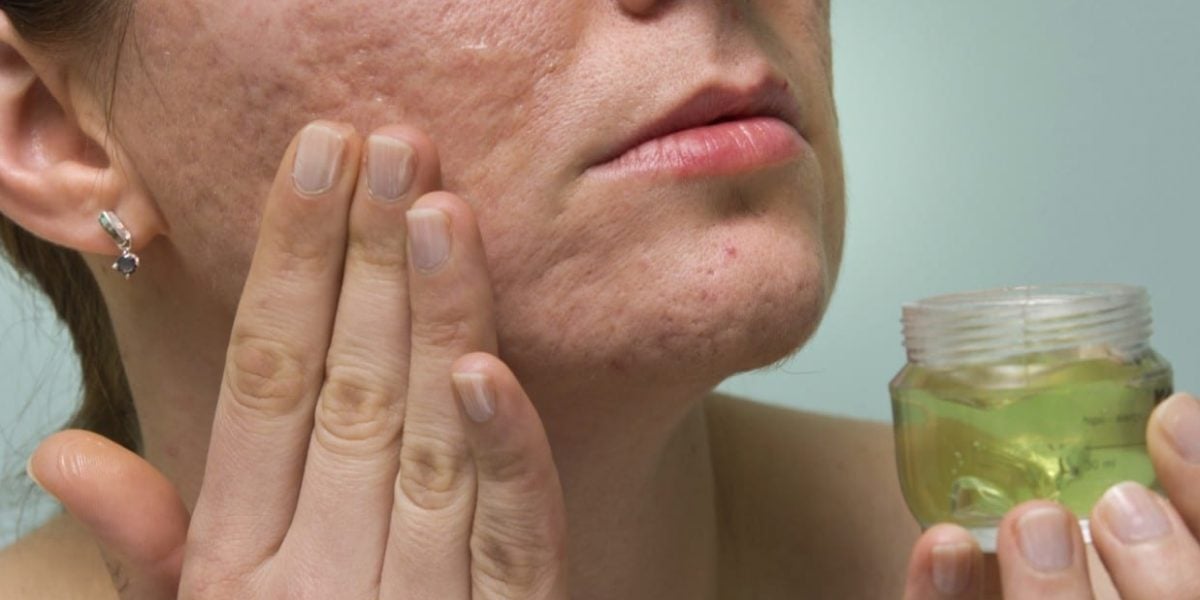 Babosa auxilia na pele do rosto (Foto: Reprodução/ Internet)