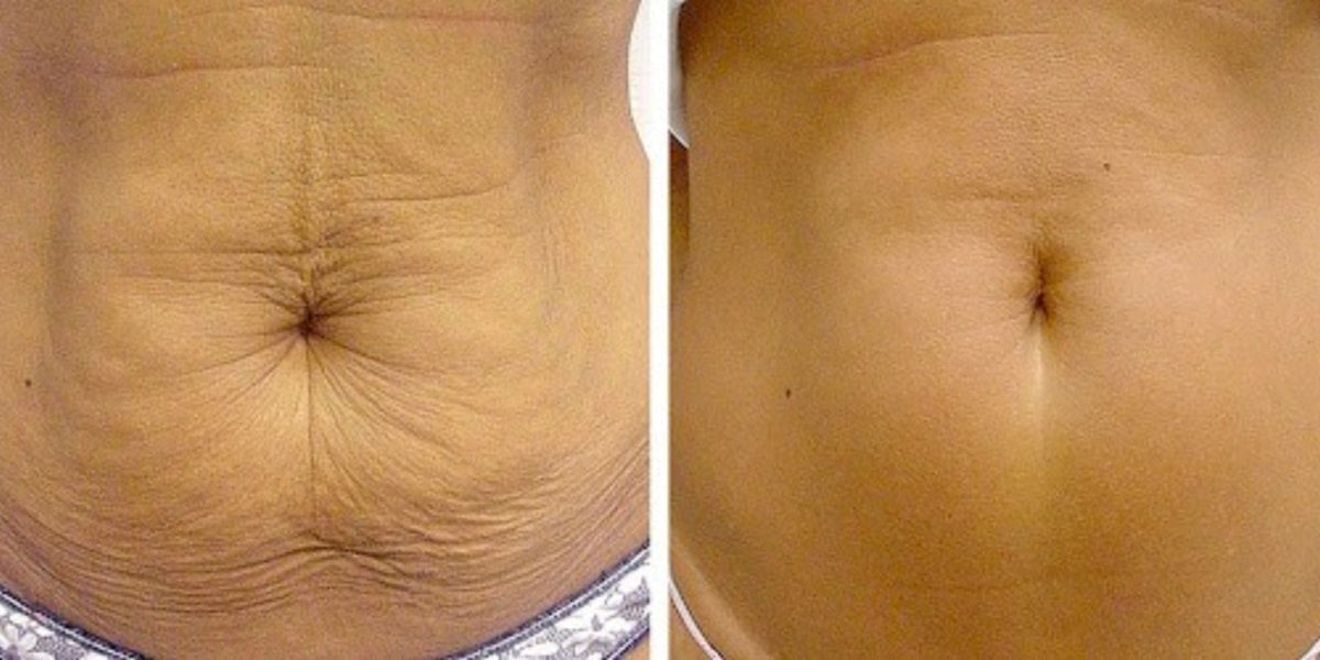 Antes e depois da barriga flácida - (Foto: Reprodução / Internet)