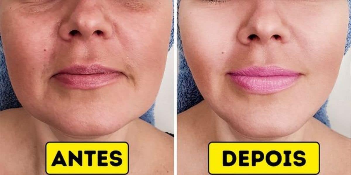 Conheça os segredos para uma pele mais jovem com resultado de harmonização facial (Foto: Pinterest)