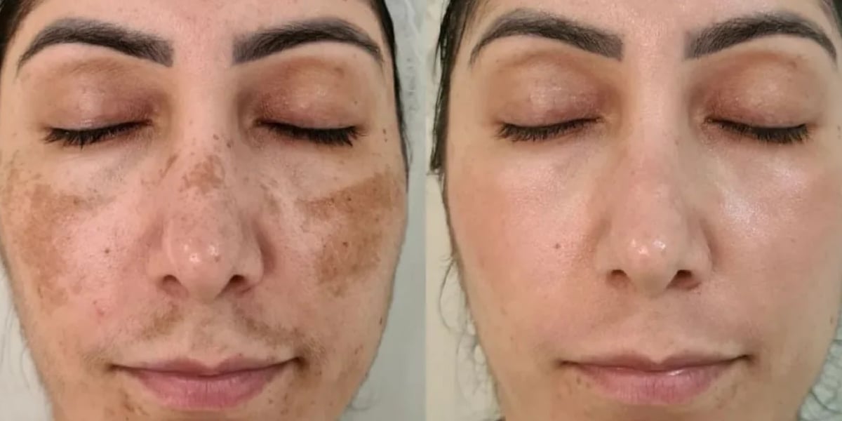 Manchas e rugas na pele (Foto: Reprodução, Beauty Face Brasil)