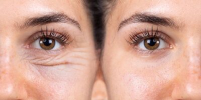 Skin with or without wrinkles (Photo: Reproduction / Internet)