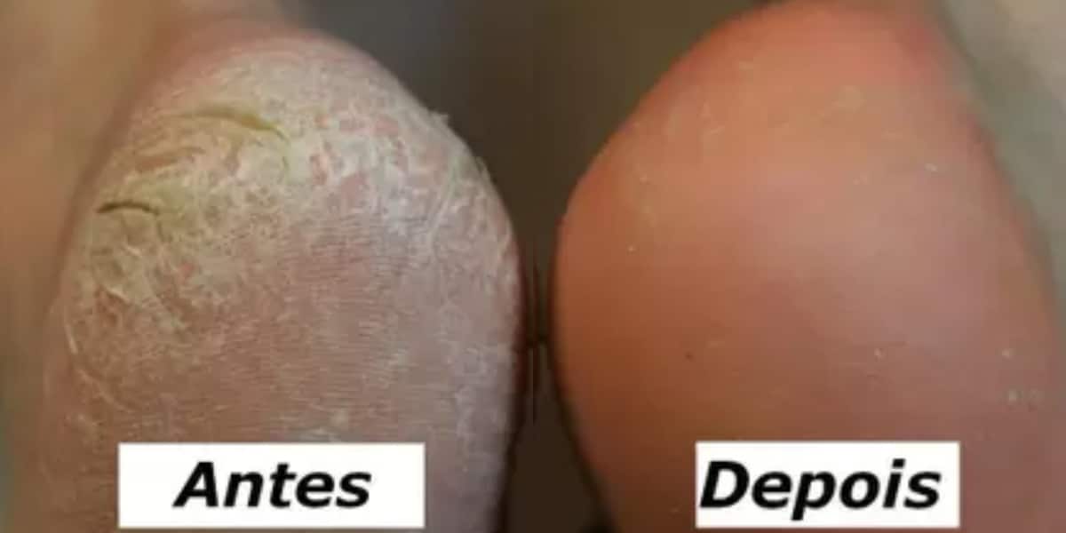 Pés rachados antes e depois de receita (Foto: Divulgação)