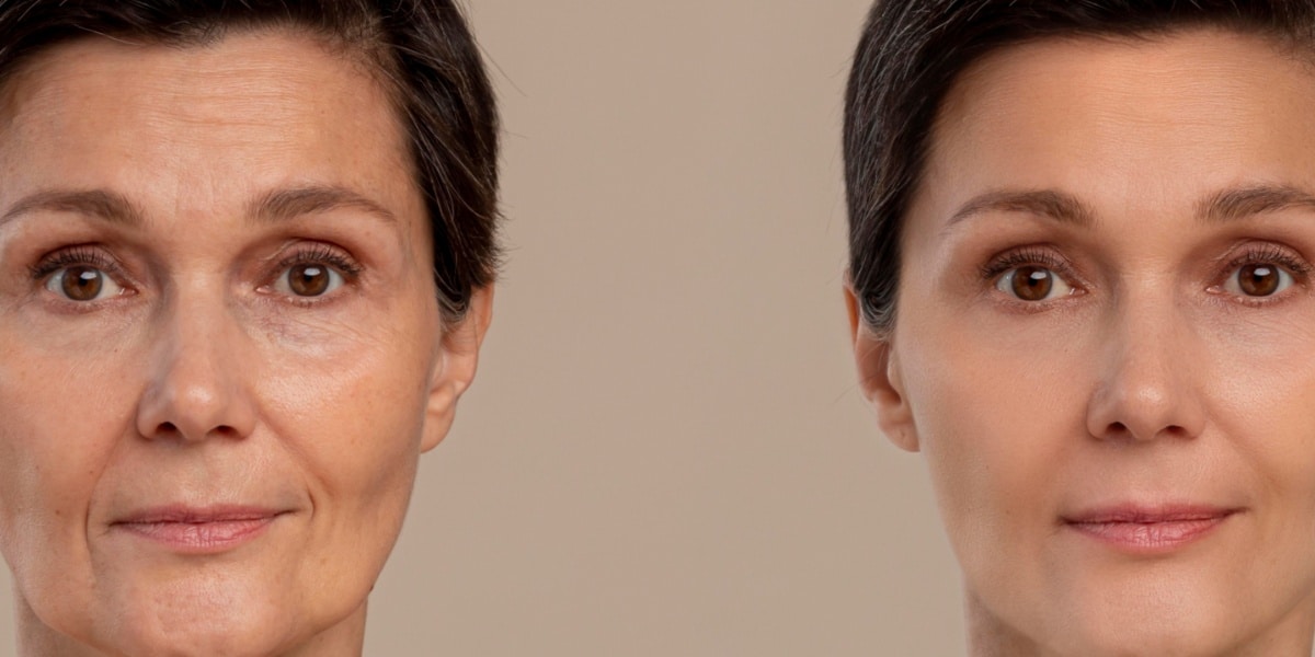 Alerta para ter uma pele incrível de porcelana e adeus ao botox (Foto: Reprodução/ Internet)