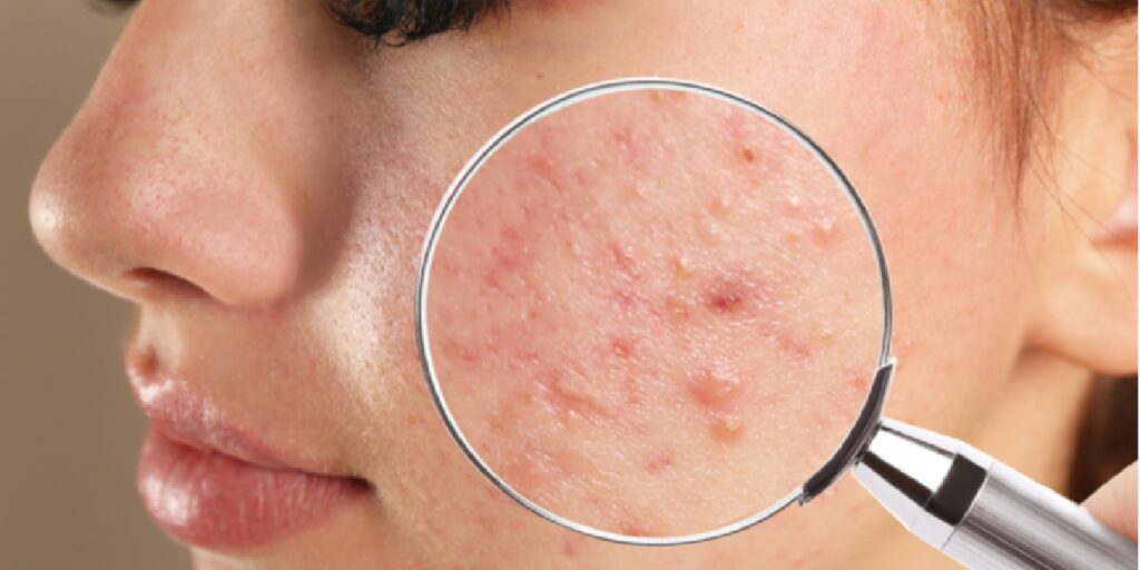 Rosto com acne (Foto: Reprodução/ Internet)