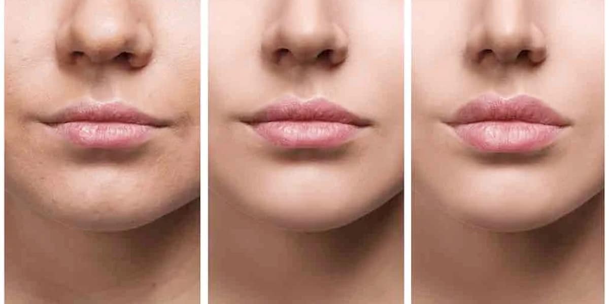 Lábios após Preenchimento labial (Foto: Reprodução, Clínica Carreirão)