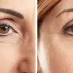 Harmonização facial caseira para tirar rugas (Reprodução: Internet)