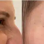 Botox caseiro com resultados excelentes de antes e depois (Foto: Reprodução/ Internet)