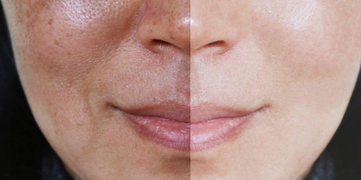 Rosto após dar adeus a melasma (Reprodução: Internet)