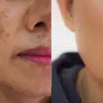 Único produto para dar fim a melasma e manchas escuras na pele (Reprodução: Montagem TV Foco)