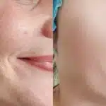 Peeling natural remove oleosidade, rugas e manchas (Reprodução: Montagem TV Foco)