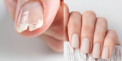 Unhas quebradas / Unhas grandes - Montagem TVFOCO