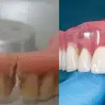 Dentaduras - Montagem: TVFOCO